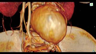 Abdominal Aortic Aneurysm ： 大動脈瘤内視鏡 [upl. by Hedveh]