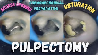 Pulpectomy  access opening  chemomechanical preparation  obturation  pulpectomy procedure 84 [upl. by Celestyna]