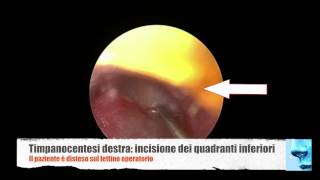 Otite media cronica glue ear aspirazione di secrezioni dalla cassa del timpano [upl. by Rafaj]