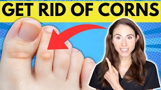 How To Get Rid Of Corns On The Feet [upl. by Ubald582]