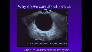 Screening of Ovarian Cancer [upl. by Bern]