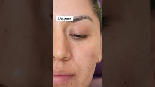 Aplicación de Ácido Hialuronico en Ojeras 😨✔ skincare derma botox ácidohialurônico filler [upl. by Benil848]