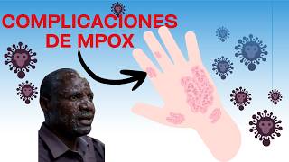 4 peores complicaciones de la viruela mpox [upl. by Senaj]