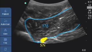 adductor muscle and sciatic nerve anterior [upl. by Zul]