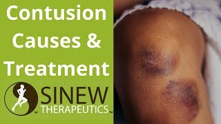 Contusion Causes and Treatment [upl. by Attikin]