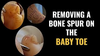 Removing a bone spur on the baby toe [upl. by Borchers]