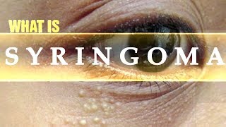 What is Syringoma  Usapang Pangkalusugan [upl. by Ydnem366]