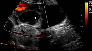 Hemorrhagic Corpus luteum cyst on Ultrasound scan [upl. by Jovitta819]