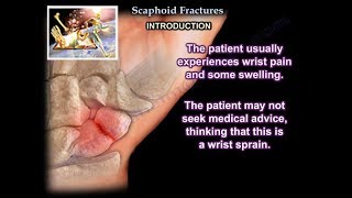 Scaphoid Fractures  Everything You Need To Know  Dr Nabil Ebraheim [upl. by Dag]