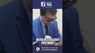 Nevus of OTA Laser Treatment  Birthmark Removal Treatment  Dr PK Talwar [upl. by Akeryt]