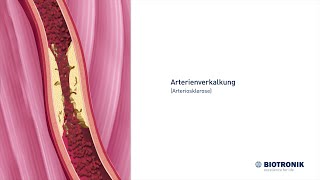 Arterienverkalkung Arteriosklerose und Angiografie [upl. by Ainet369]