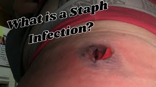 STAPH INFECTIONS with PICTURES  what is a staph infection [upl. by Williamsen]