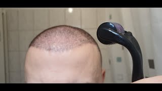 Minoxidil amp Dermarolling Results 6 MONTHS  Month by Month Progress [upl. by Wymore]