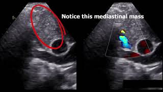 SVC syndrome diagnosis by echocardiography [upl. by Russi]