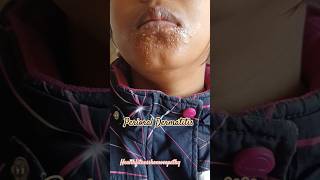 Perioral Dermatitis skincareinhindi dermatitis skin allergy homoeopathy [upl. by Pacian787]