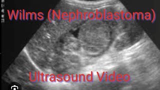 NEPHROBLASTOMA Wilms Tumor ultrasound appearence on video demonstration [upl. by Nwotna]