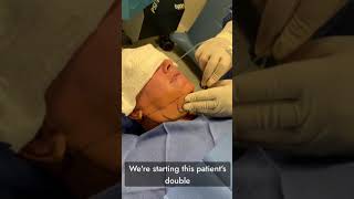 Demonstration of Double Chin Liposuction [upl. by Clarissa328]