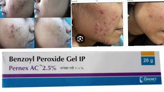 Pernex AC 25 Gel Benzoyl Peroxide Gel [upl. by Ferro726]