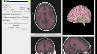 Electrode Grid Visualization with Analyze 100  Webinar [upl. by Ahsikym]