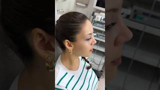 Rhinoplasty Result 👃🏻 Dr Ahmet Dilber 🪄 rhinoplastyturkey plasticsurgery [upl. by Vincentia]