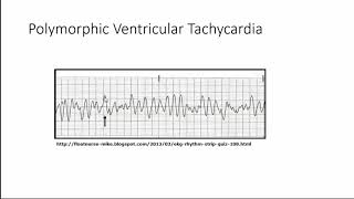 Polymorphic VT [upl. by Leonhard]