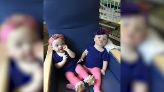 6 Months After Being Separated Formerly Conjoined Twins Are Doing Great [upl. by Billmyre448]