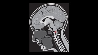 Kraniozervikale Instabilität bei EDS  Craniocervical Instability in EDS [upl. by Pallaton]