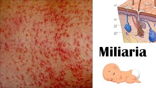 Miliaria Heat rash [upl. by Landmeier658]