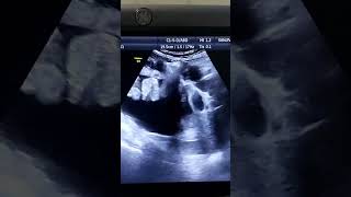 Liver Cirrhosis Ascites with floating Bowel loopsshorts [upl. by Ahsin653]