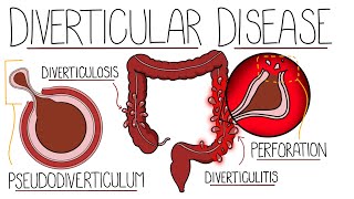 Understanding Diverticular Disease Diverticulosis and Diverticulitis [upl. by Remde540]