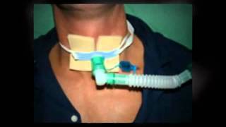 Sleep Apnea Surgery Treatment Tracheostomy  Part 3 [upl. by Imoyaba594]