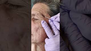 Acne extraction of blackheads and whiteheads popping pimples in Los Angeles [upl. by Katti]