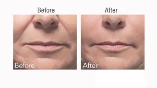 Botox vs Dermal Fillers [upl. by Nosneb569]