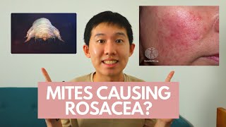 MANAGEMENT OF ROSACEA [upl. by Liam]