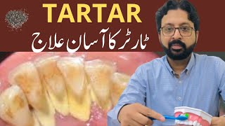 How to Remove TARTAR from Teeth at Home Naturally [upl. by Bindman]