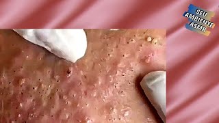 Retirando cravos no rosto  Acne treatment  Vídeo satisfatório 099 [upl. by Asital]