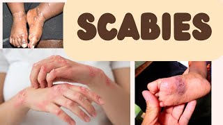 Scabies  dermatological conditions  Medical surgical nursing  management amp prevention [upl. by Gambell]