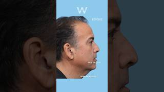 Before and after results Submentoplasty Deep Neck Lift with a Chin Implant [upl. by Ivel]