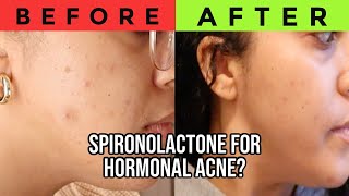 My 1 Month Experience on SPIRONOLACTONE for HORMONAL ACNE BEFORE  AFTER amp skincare routine [upl. by Maharba]