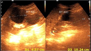 Renal cortical cyst  Milk of calcium cyst  Renal calcification [upl. by Chiaki]