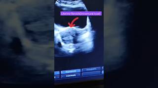 Uterine fibroidsultrasound imagesfibroidsintramural typeytshortshortvideo [upl. by Hinch]