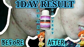 LUXXE PROTECT FRONTROW TESTIMONIALS REVIEW 1 DAY RESULT DRIES UP PIMPLE [upl. by Ivz211]