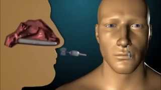 Rapid Rhino Epistaxis Device [upl. by Euseibbob148]