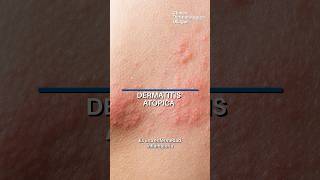 Dermatitis atopica dermatologia [upl. by Florio968]