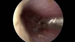 Ear tube placement myringotomy [upl. by Esikram]