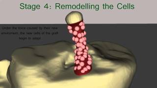 The Healing Process of the ACL Graft [upl. by Lehcear]