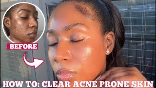 HOW I CLEARED MY ACNE SCARS amp HYPERPIGMENTATION FOR GOOD IN ONE MONTH  3 STEPS FOR FLAWLESS SKIN [upl. by Angeli]