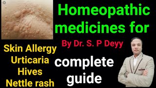 Homeopathy medicines for skin allergy  urticaria  nettel rash  itching  skin problems [upl. by Atirma]