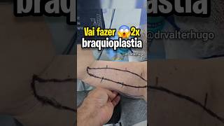 FEZ BRAQUIOPLASTIA E 😱FICOU ASSIM cirurgiadebraços braquioplastia drvalterhugo [upl. by Voccola]