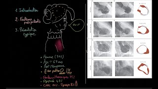 Cardiomyopathie de Takotsubo  Docteur Synapse [upl. by Farrel]